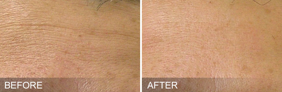 HydraFacial - Before & After for Fine Lines